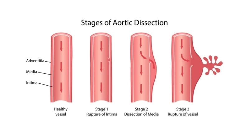 Aortic dissection recovery and long term care