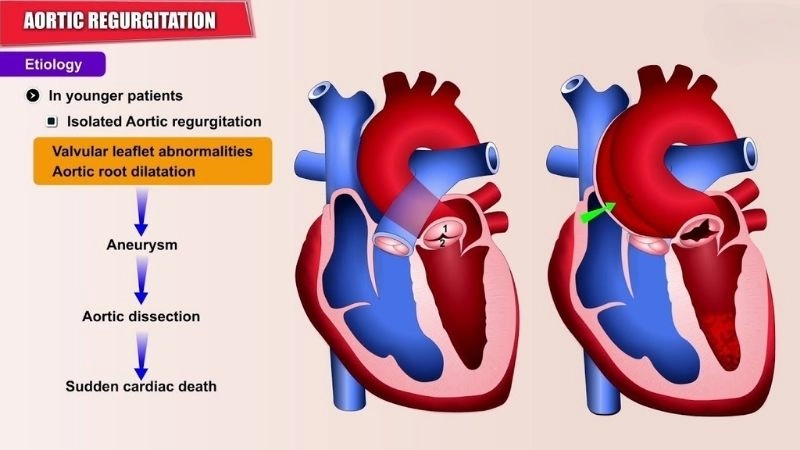 Aortic Regurgitation Symptoms include shortness of breath