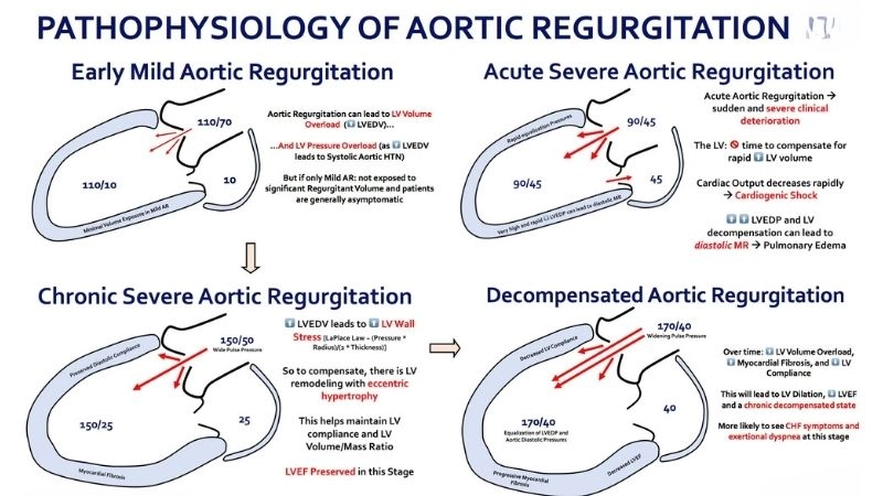 Severe Aortic Regurgitation increases risk of failure