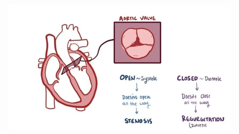 Aortic Regurgitation Diagnosis confirmed with echocardiogram