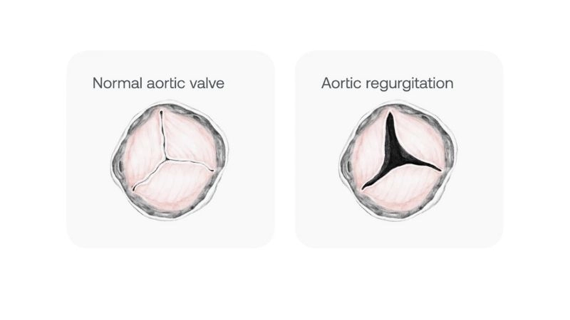 Aortic Regurgitation Murmur classic diastolic sound