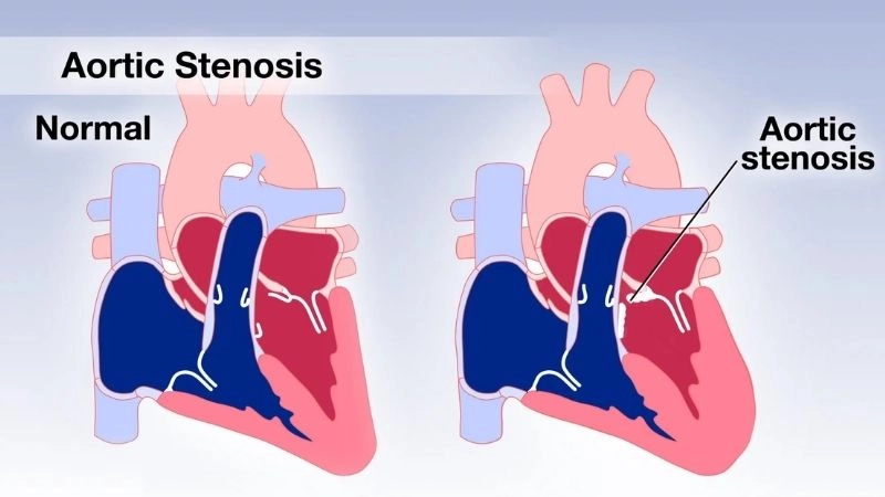 Aortic Stenosis Symptoms include chest pain and fainting