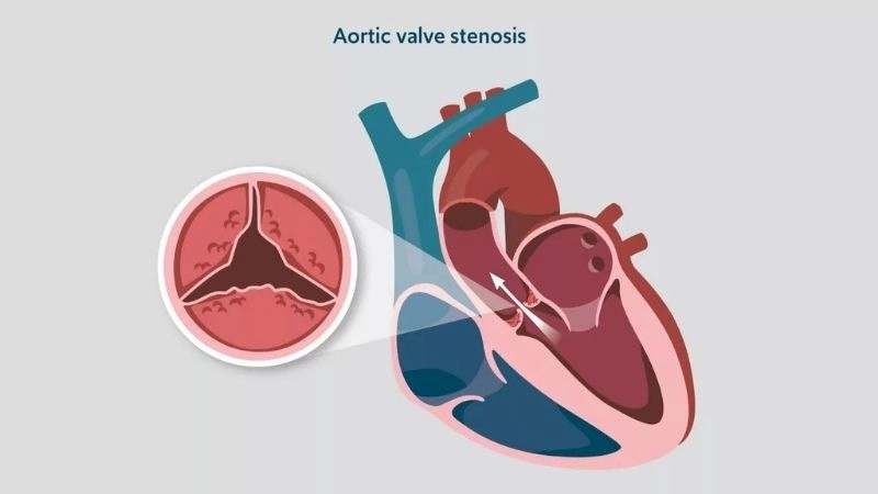 Aortic Stenosis Treatment helps improve blood flow