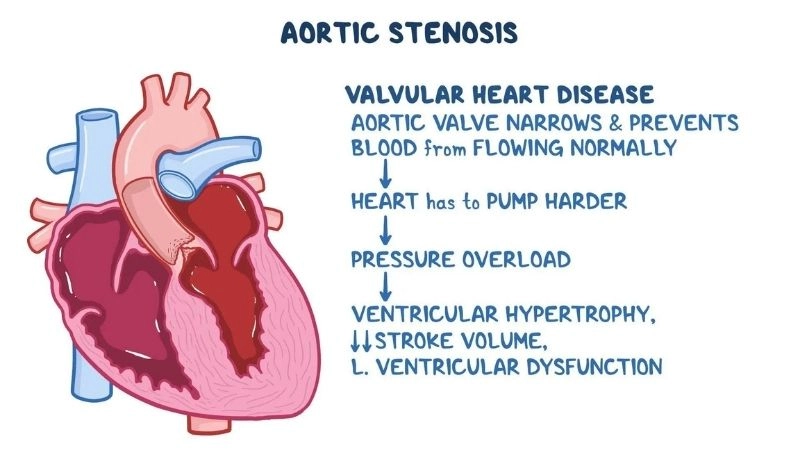 Aortic Stenosis Causes linked with aging and calcium