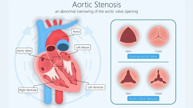 Severe Aortic Stenosis leads to life threatening risk