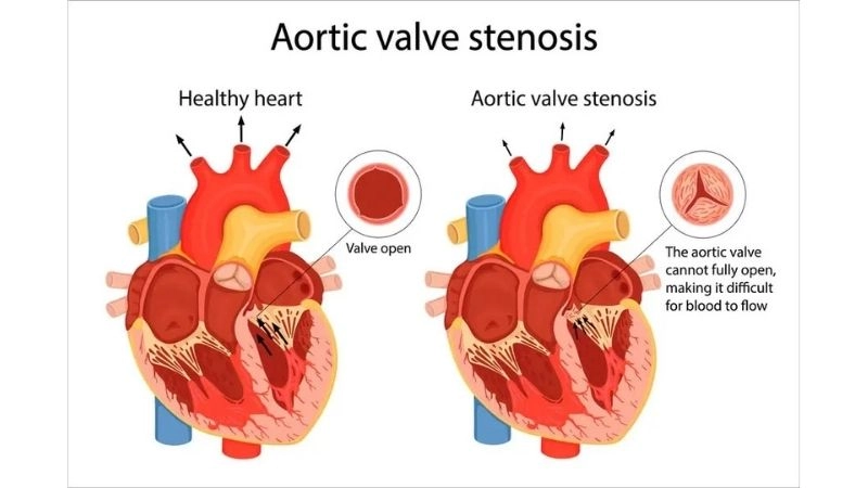 Aortic Stenosis In Elderly common degenerative condition
