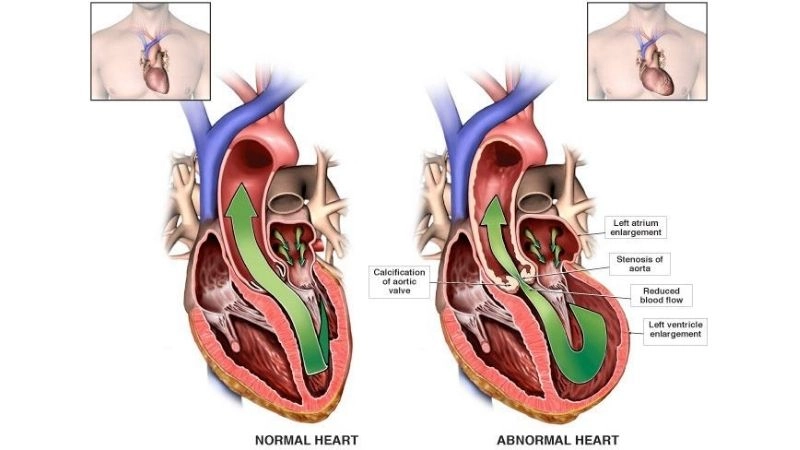 Aortic Valve Replacement restores normal blood circulation