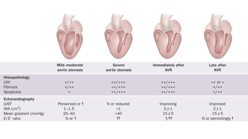 Aortic Stenosis Prognosis depends on timely treatment