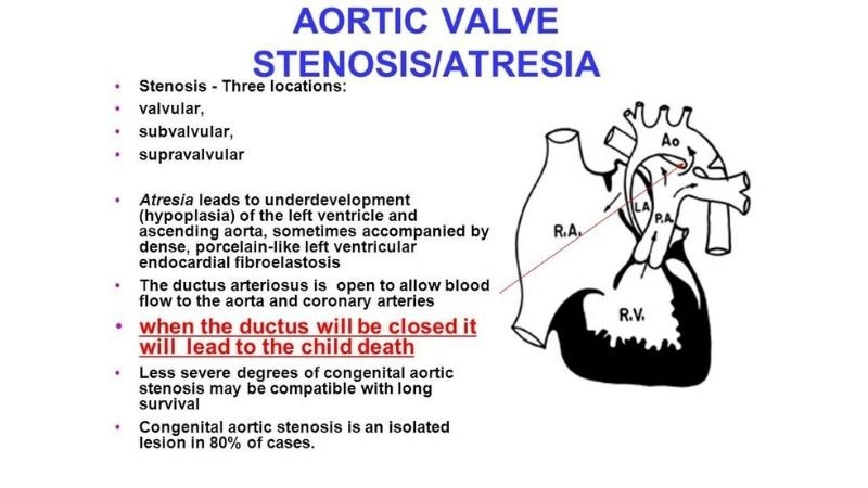 Aortic valve atresia symptoms and early warning signs