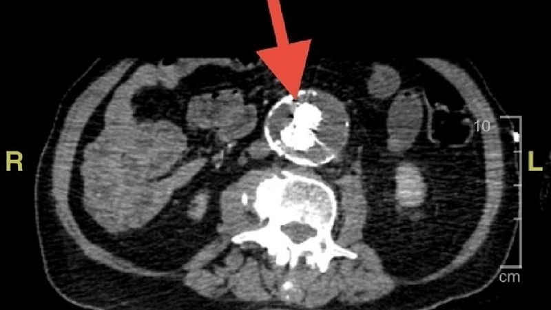 Takayasu arteritis as a rare vascular disorder
