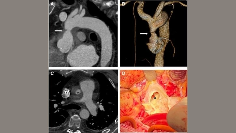 Main aortitis causes and underlying health factors