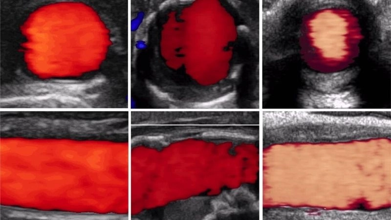 Aortitis diagnosis with advanced medical imaging