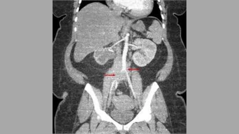 Aortitis vs atherosclerosis and key differences