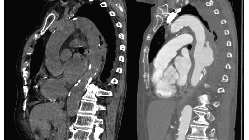 Aortic aneurysm as a complication of aortitis