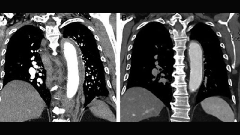 Large vessel vasculitis affecting major arteries