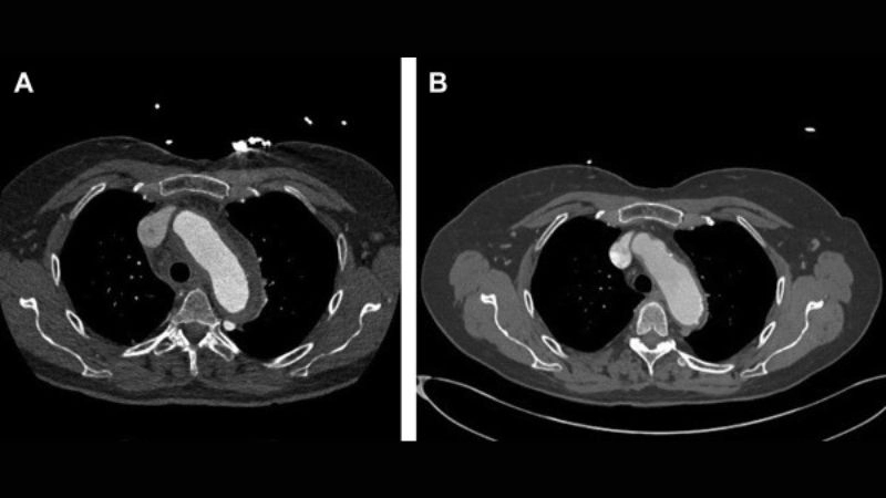 Aortitis and rheumatoid arthritis strong connection