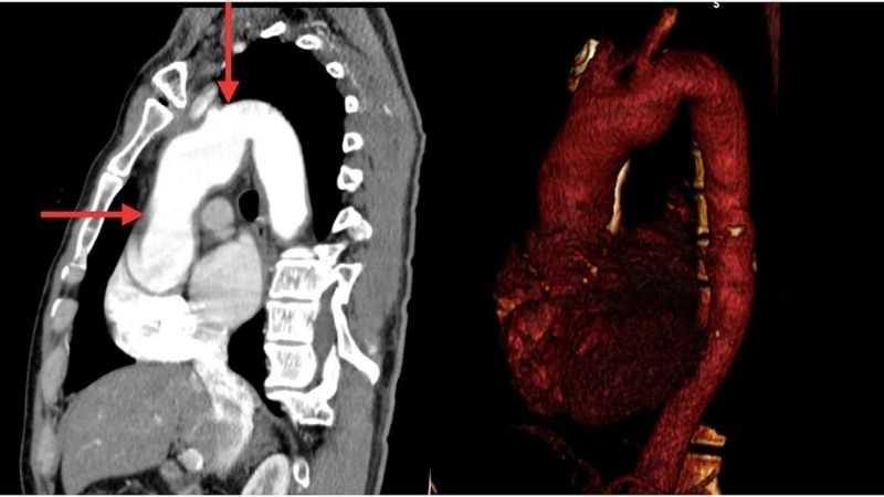 Aortitis in children and its unique challenges
