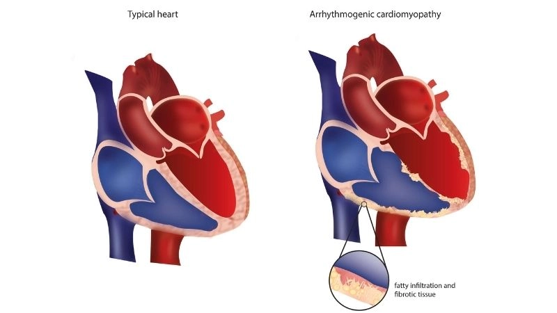 Arrhythmogenic Right Ventricular Cardiomyopathy treatment uses meds, ICD, or ablation
