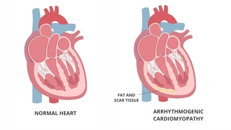 ARVC genetics often involve mutations in desmosomal proteins