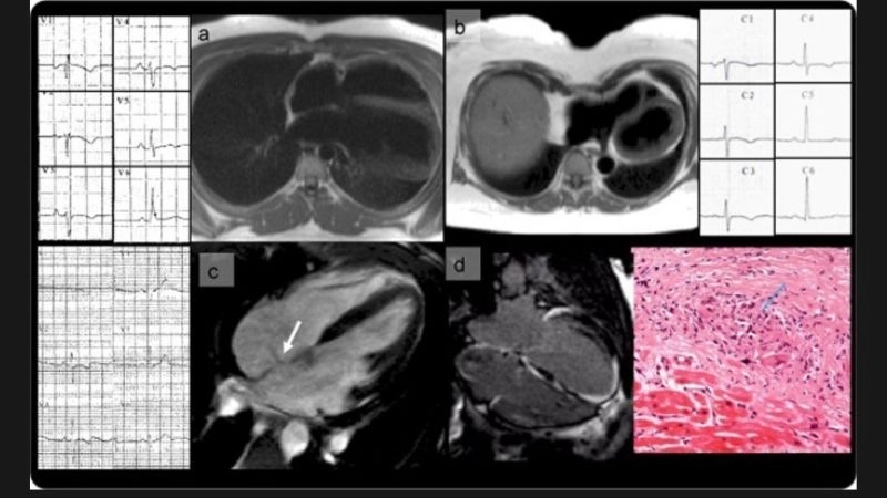 ARVC patient stories show daily struggles