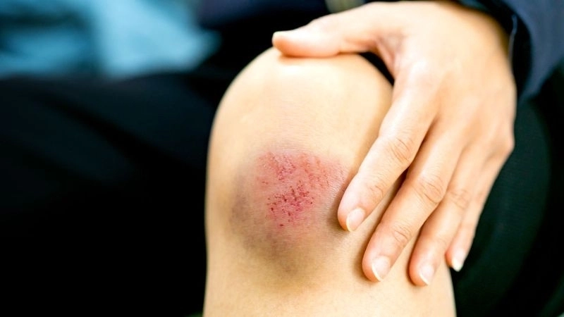 Astrovirus Infection managed by astrovirus treatment