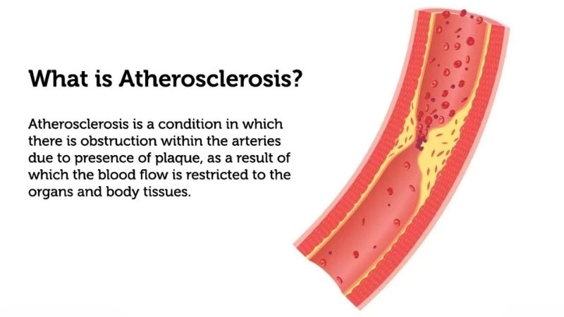 Simple words for clear atherosclerosis meaning