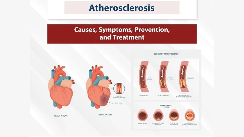 Standard medical atherosclerosis definition today