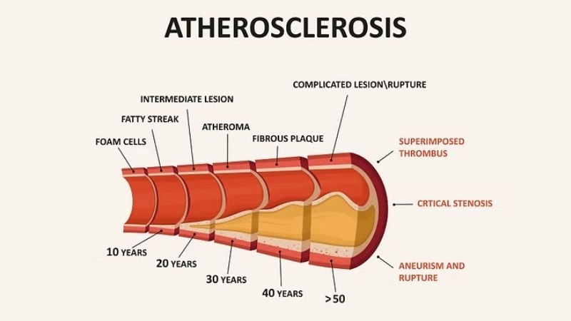 Alarming warnings of atherosclerosis symptoms