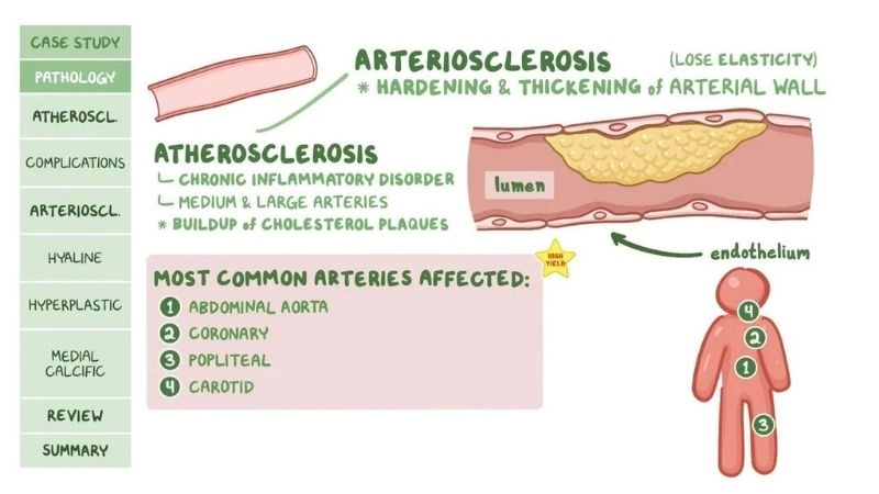 Key early signs of atherosclerosis detected