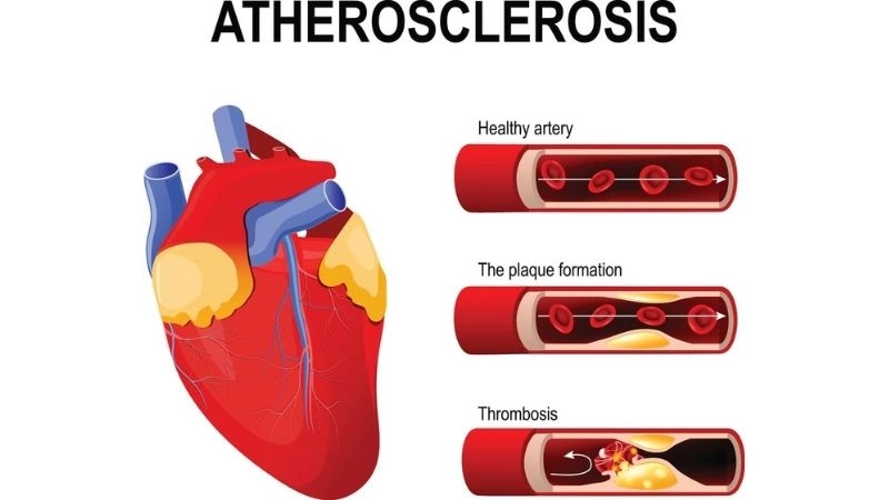 Medical coding for aortic atherosclerosis ICD 10