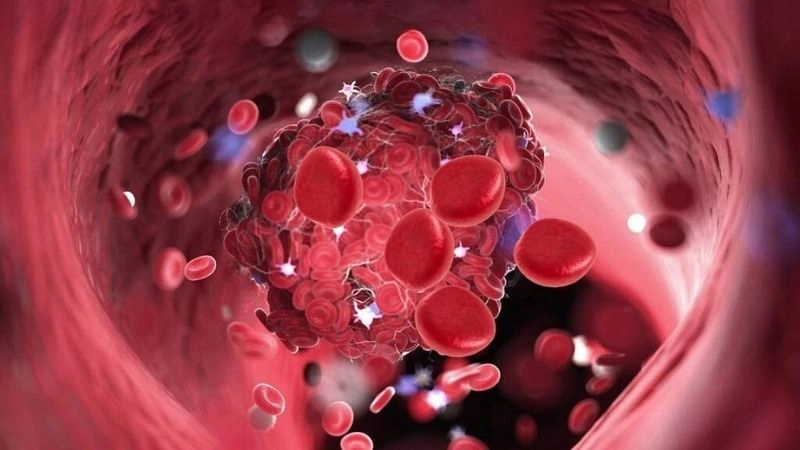 Detailed insights into atherosclerosis pathology