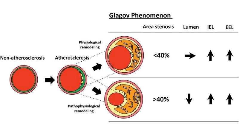 Stepwise progress of atherosclerosis pathogenesis
