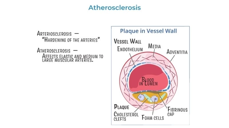 Educational guide in atherosclerosis PPT format