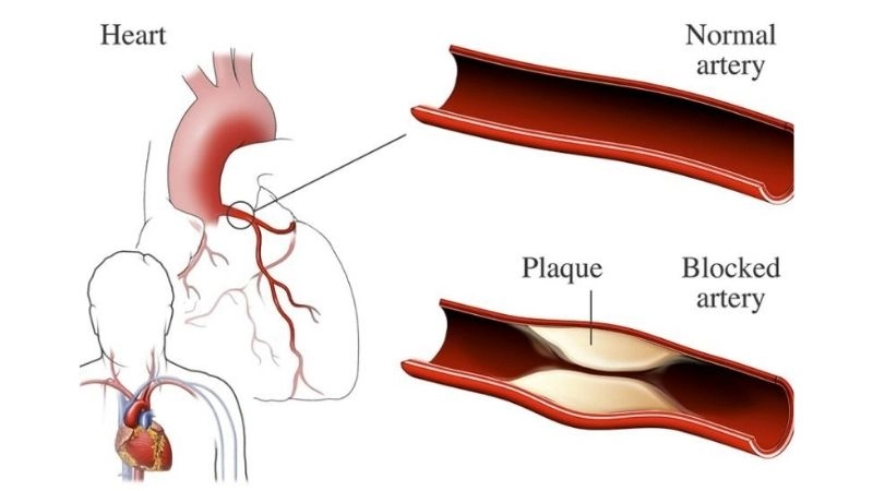 Common hidden atherosclerosis causes explained