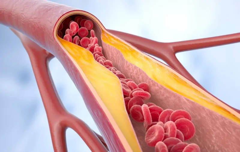 Angioplasty as an atherosclerosis treatment