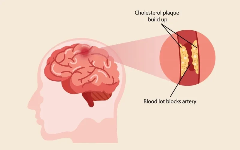 Illustration of common atherosclerosis symptoms