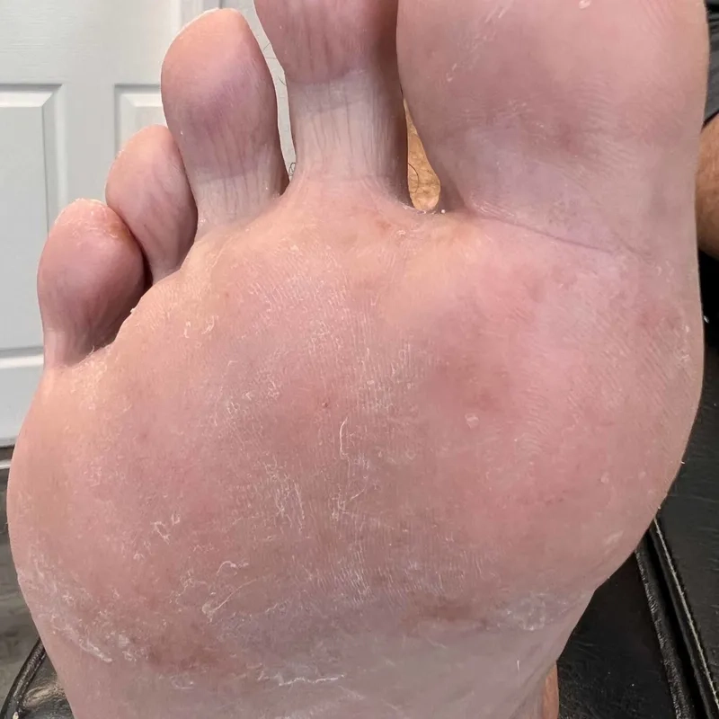 Applying antifungal cream for athlete's foot