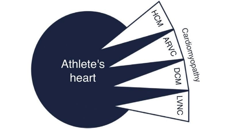 Common athlete's heart EKG changes explained