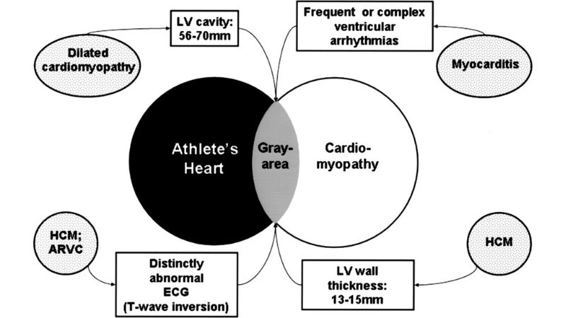 Modern options for athlete's heart treatment