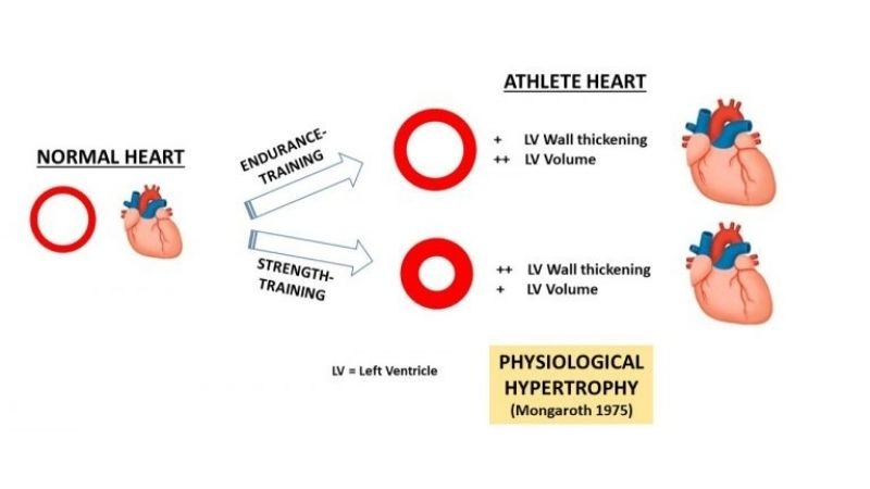 Distinction of athlete's heart vs enlarged heart