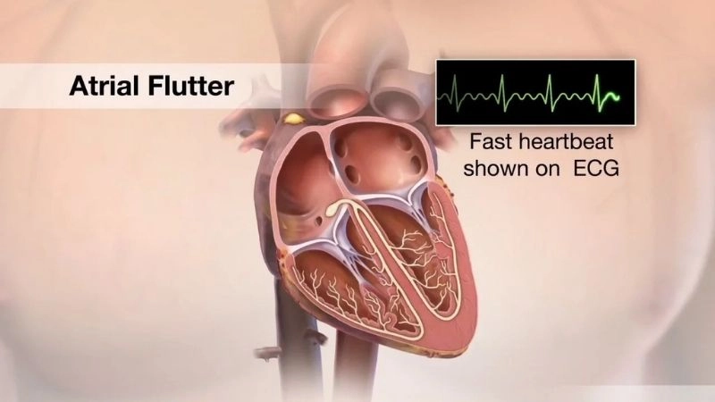 What is atrial flutter explained with clear heart insights