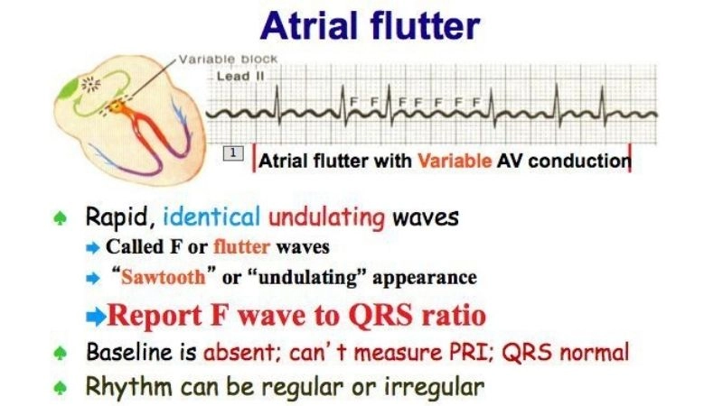 Atrial flutter heart rate often beats dangerously fast