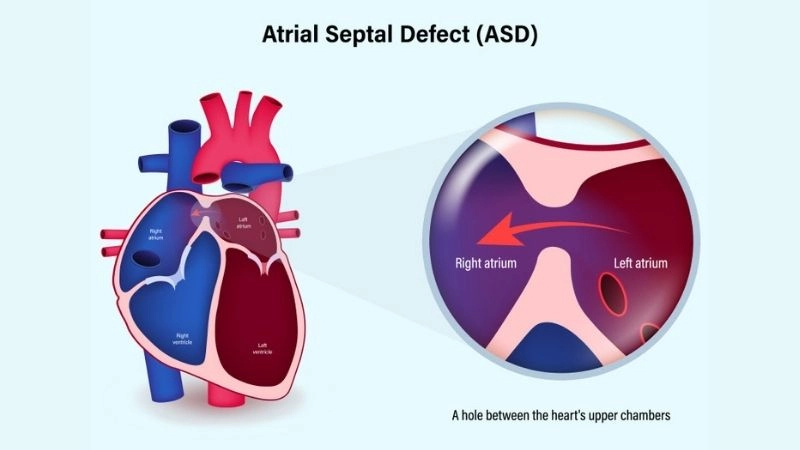 Atrial septal defect treatment managing condition effectively