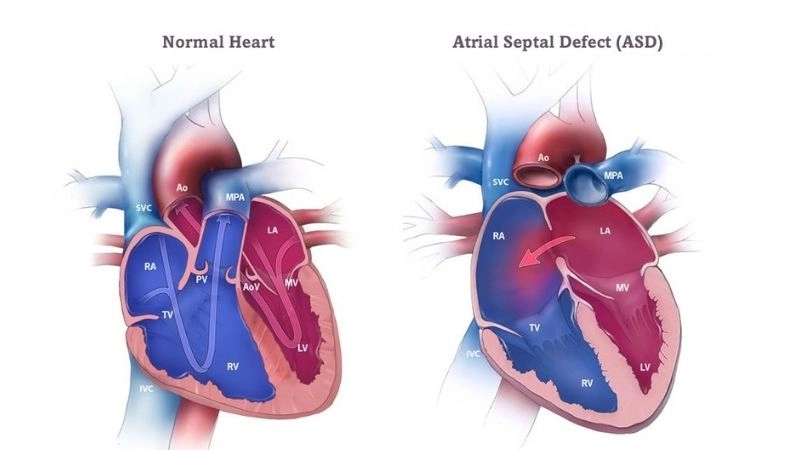 Atrial septal defect surgery repairing hole in the heart