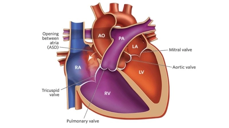 Atrial septal defect in adults late diagnosis and risks