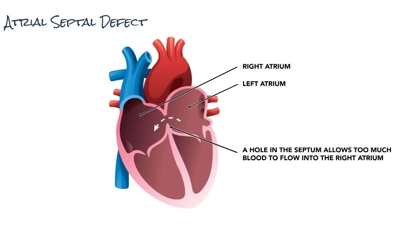 Atrial septal defect in children common congenital condition