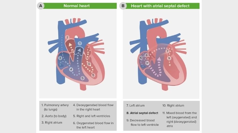 Types of atrial septal defects different forms of the defect
