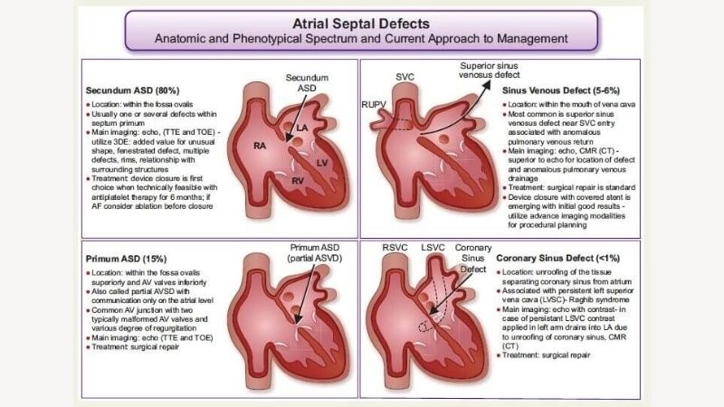 Secundum atrial septal defect most frequent type detected