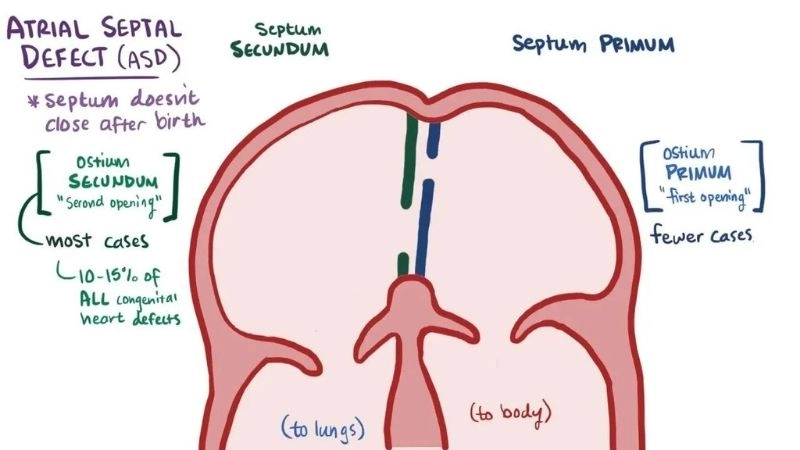 Atrial septal defect closure sealing the heart opening