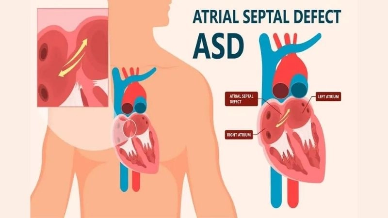 Atrial septal defect repair improving long term heart health